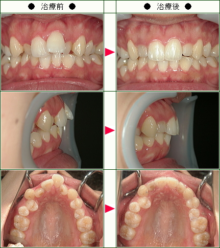 歯のデコボコ矯正症例(Ａ．Ｓ様　２７歳　女性)