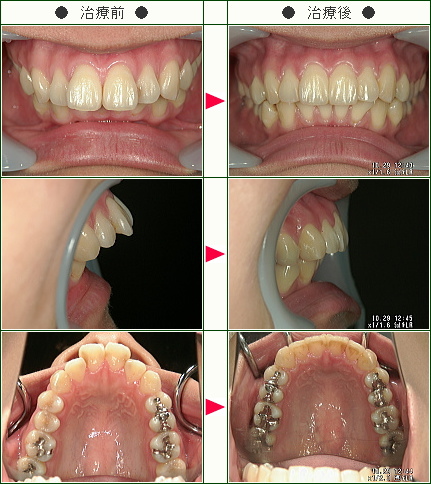 出っ歯矯正症例(Ａ・Ｓ様　２７歳　女性)