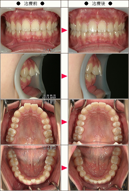 出っ歯矯正症例［Ａ．Ｓ様　２７歳　女性］