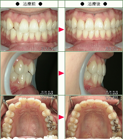 歯のデコボコ矯正症例(Ａ・Ｓ様　３３歳　女性)