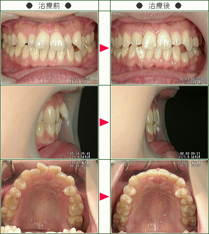 歯のデコボコ矯正症例(Ａ・Ｓ様　３３歳　女性)