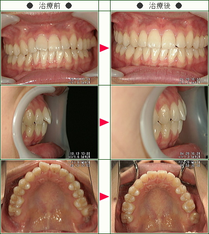 歯のデコボコ矯正症例(あすか様　２２歳　女性)