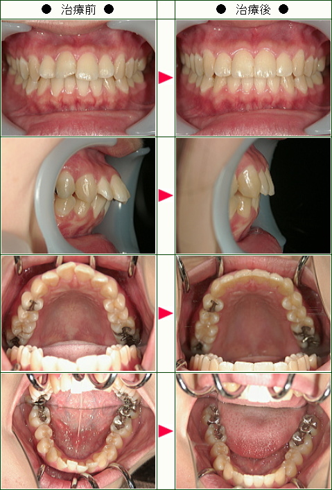 出っ歯矯正症例(Ａ．Ｔ様　２２歳　女性)