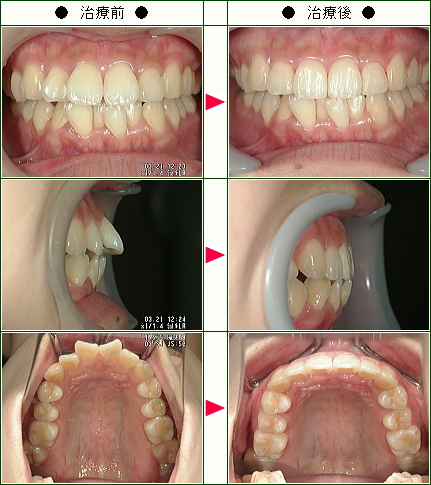 出っ歯矯正症例(Ａ・Ｔ様　２５歳　女性)