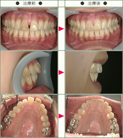 前歯のすきっ歯矯正症例(敦美様　３０歳　女性)