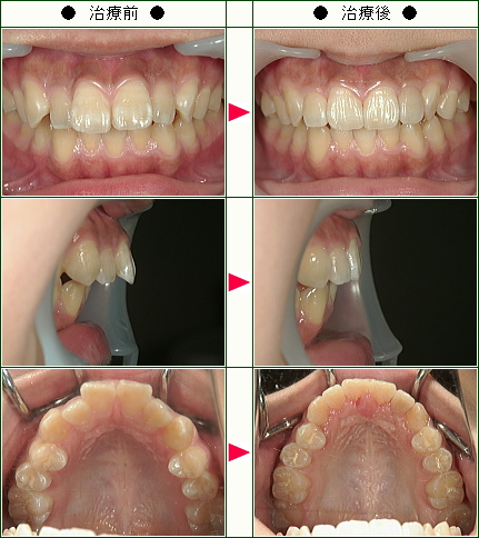 歯のデコボコ矯正症例(Ａ.Ｗ様　１５歳　女性)