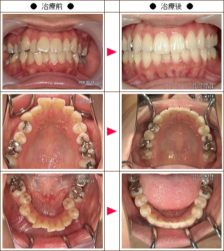 歯のデコボコ矯正症例［a・w様　２１歳　女性］