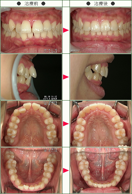 前歯のすきっ歯矯正症例(Ａ，Ｙ様　２８歳　女性)