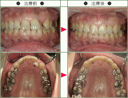 歯のデコボコ矯正症例(Ａ．Ｙ様　４５歳　女性)