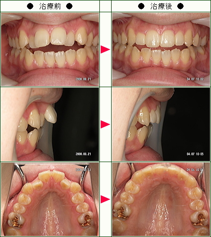 出っ歯矯正症例(綾様　２４歳　女性)