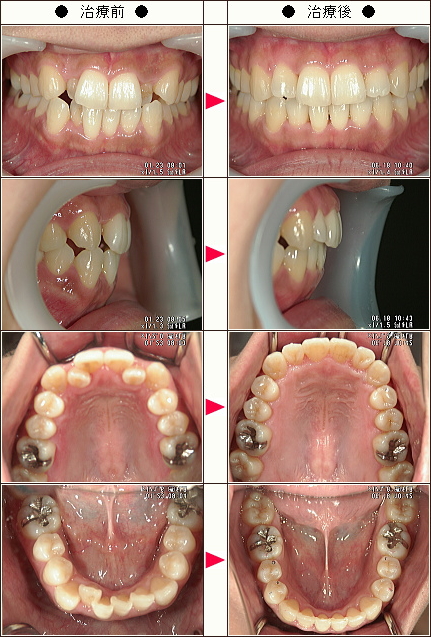 歯のデコボコ矯正症例［ＡＹＡ様　３１歳　女性］