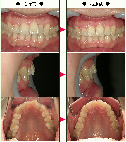 歯のデコボコ矯正症例(綾子様　３６歳　女性)