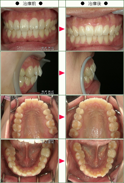 出っ歯矯正症例(あやみ様　２５歳　女性)