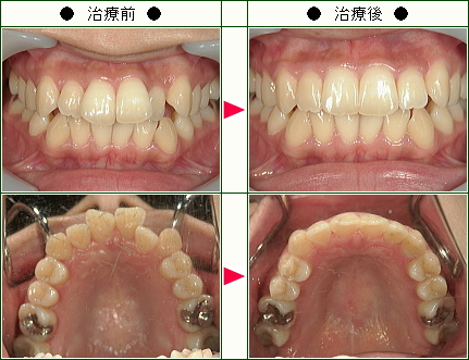 歯のデコボコ矯正症例(あゆみ様　２９歳　女性)