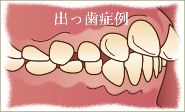 出っ歯矯正治療解説