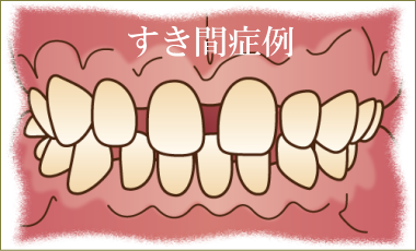前歯のすきっ歯矯正治療解説