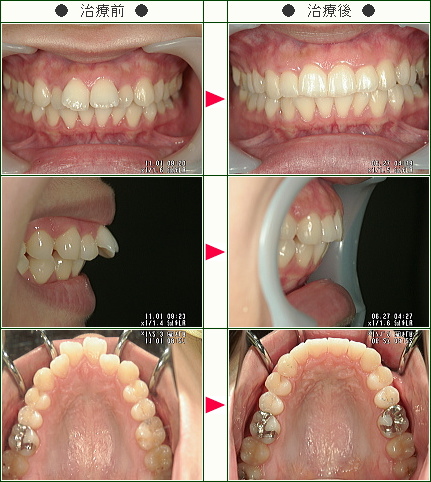出っ歯矯正症例(Ｃ様　２２歳　女性)