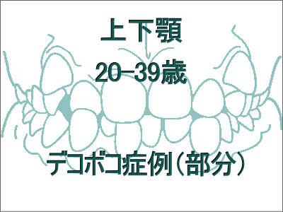 歯のデコボコ矯正(上下の症例)-20歳から39歳まで