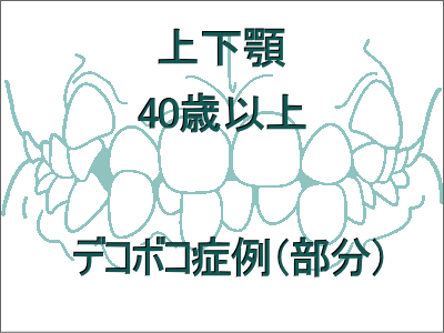歯のデコボコ矯正(上下の症例)-40歳以上