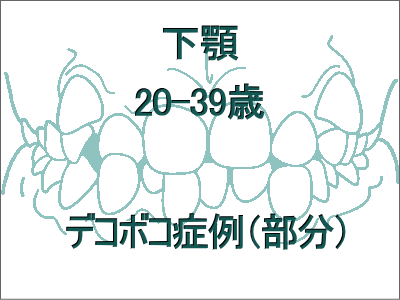 歯のデコボコ矯正(下だけの症例)-20歳から39歳まで