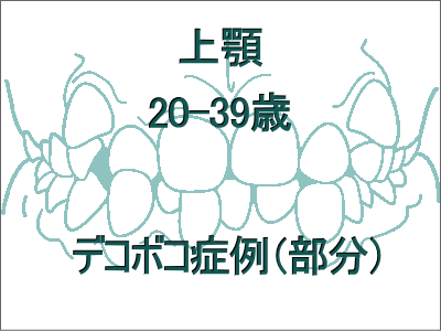 歯のデコボコ矯正(上だけの症例)-20歳から39歳まで