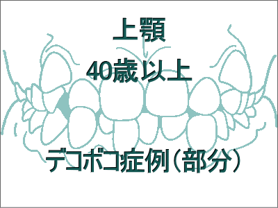 歯のデコボコ矯正(上だけの症例)-40歳以上