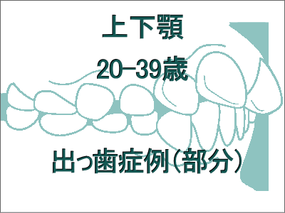 出っ歯矯正症例(上下の症例)-20歳から39歳まで