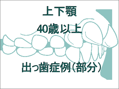 出っ歯矯正症例(上下の症例)-40歳以上