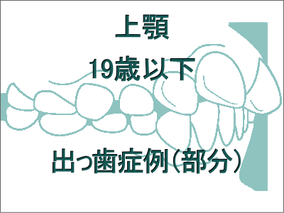 出っ歯矯正症例(上だけの症例)-19歳以下