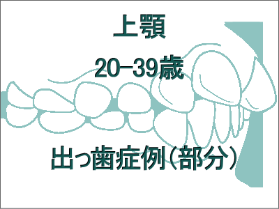 出っ歯矯正症例(上だけの症例)-20歳から39歳まで