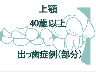 出っ歯矯正症例(上だけの症例)-40歳以上