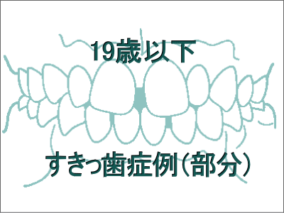 前歯のすきっ歯矯正症例-19歳以下