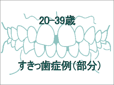 前歯のすきっ歯矯正症例-20歳から39歳まで