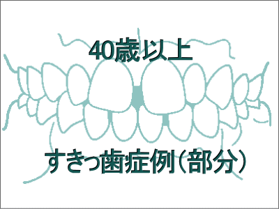 前歯のすきっ歯矯正症例-40歳以上