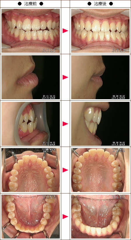 受け口矯正症例(Ｋ様　１６歳　女性)
