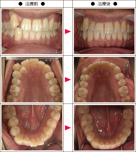 歯のデコボコ矯正症例［Cathy23様　３３歳　男性］