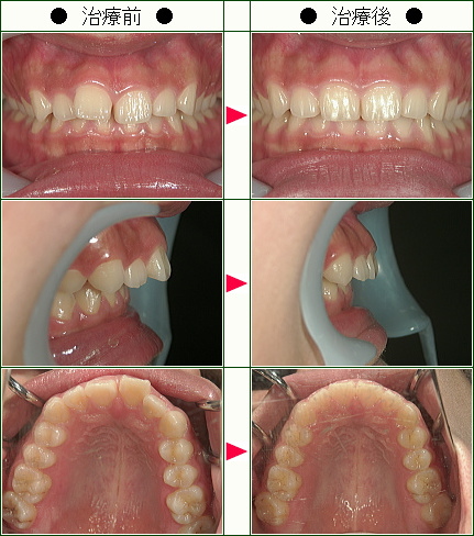 歯のデコボコ矯正症例(Ｃ.Ｈ様　１８歳　女性)