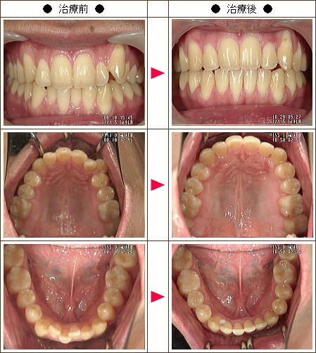 歯のデコボコ矯正症例［チャッピー様　２４歳　男性］