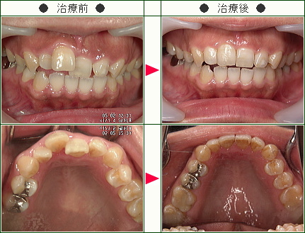 歯のデコボコ矯正症例(Ｃｈｉｅ９２０様　３８歳　女性)