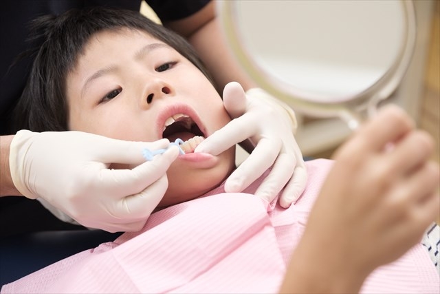 中学生のうちに歯の矯正を始めるメリットは多い？