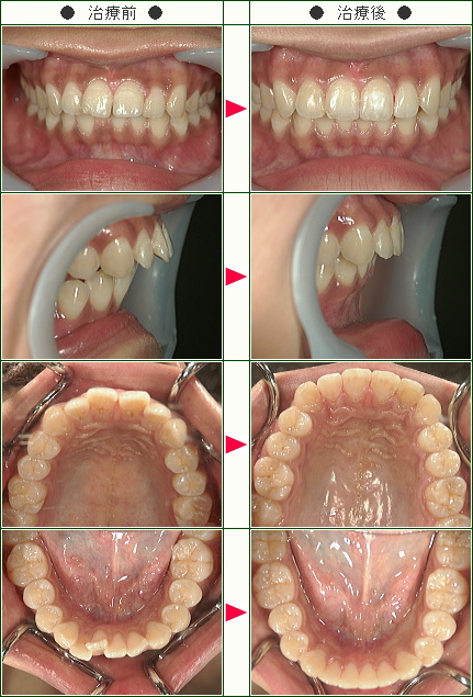 歯のデコボコ矯正症例(Ｃ.Ｉ様　２３歳　女性)
