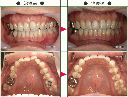 歯のデコボコ矯正症例(Ｃ.Ｉ.様　３６歳　女性)
