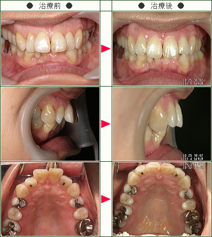 出っ歯矯正症例(Ｃ・Ｉ様　５１歳　女性)