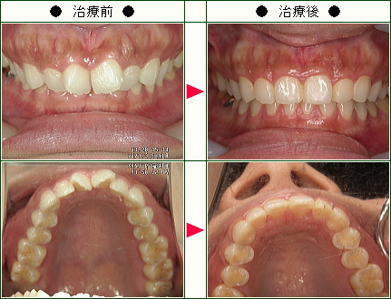 歯のデコボコ矯正症例(Ｃ・Ｎ様　２６歳　女性)