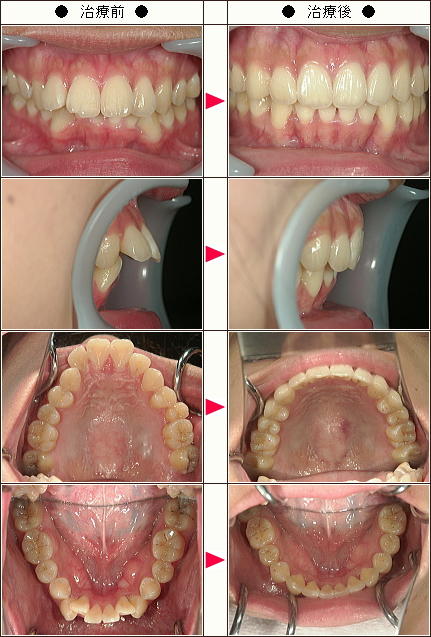 出っ歯矯正症例［クッキー様　２２歳　女性］