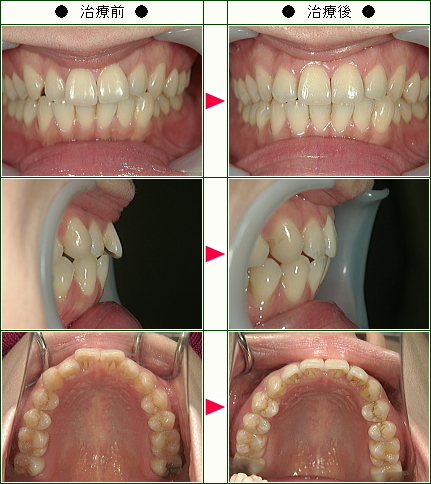 歯のデコボコ矯正症例(Ｃｒｙｓｔａｌ様　３４歳　女性)