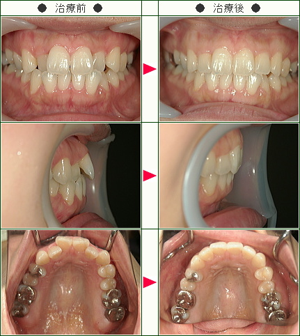 歯のデコボコ矯正症例(Ｃ.Ｓ様　３８歳　女性)