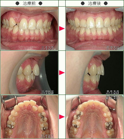 歯のデコボコ矯正症例(ＣＳＬ様　２７歳　女性)