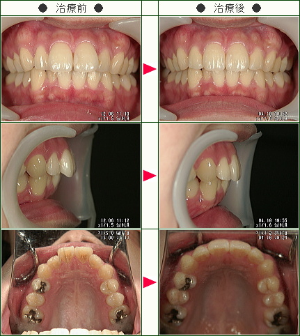 歯のデコボコ矯正症例(Ｃ.Ｙ.様　２３歳　女性)