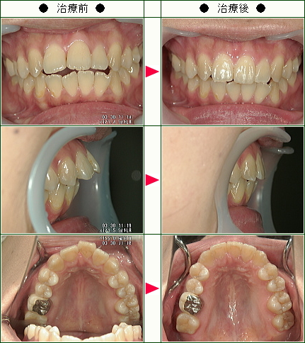 出っ歯矯正症例(伊達様　２９歳　女性)